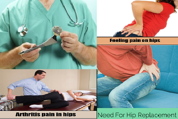 when-should-have-hip-replacement
