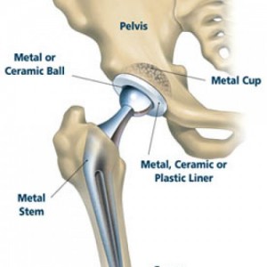 hip replacement