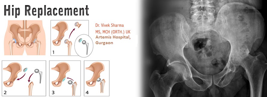 Why Ireland, UK & New Zealand have been doing more LOW Cost Hip replacement surgeries in India? – 2026