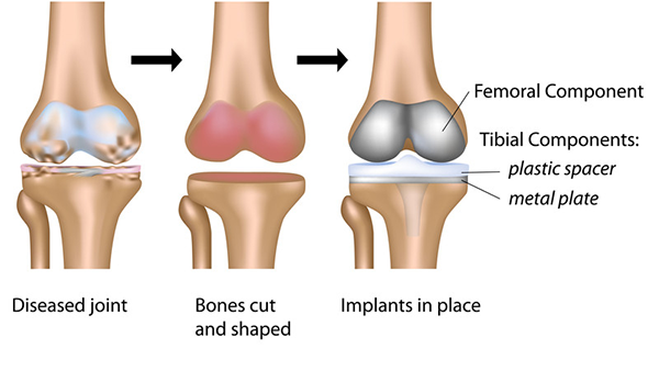 knee replacement