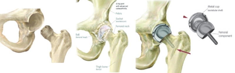 hip resurfacing2