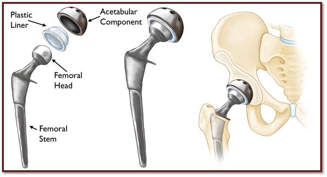 minimally-invasive-hip-surgery