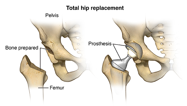 Total Hip Replacement Surgery