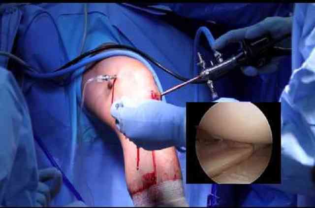 Meniscus Repair