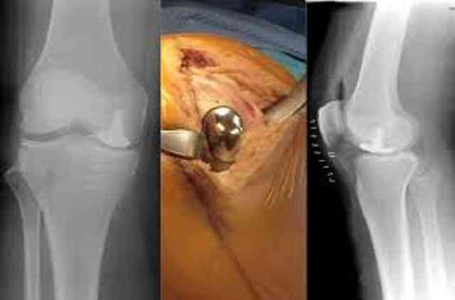 Partial Knee Replacement