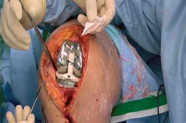 Knee Replacement