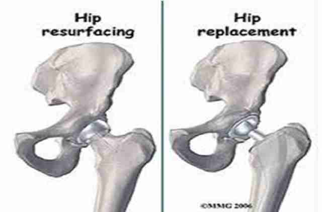 Birmingham Hip Resurfacing