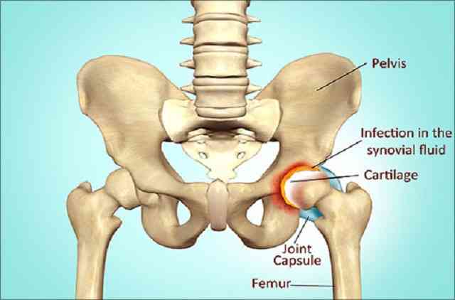 fosse septique articulation de la hanche