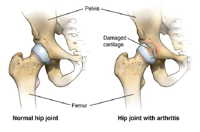 hip replacement