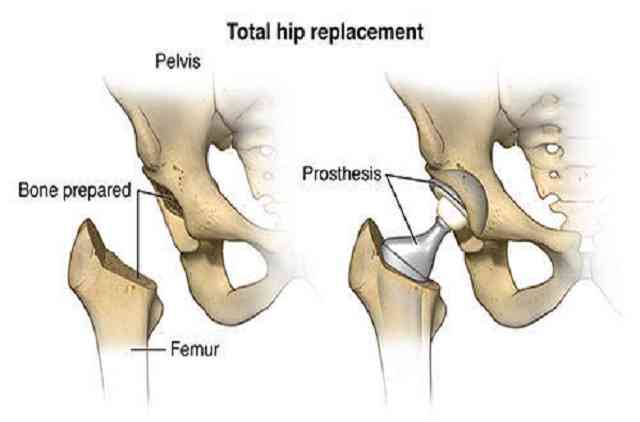 total hip replacement surgery