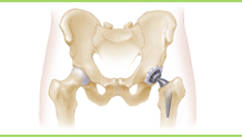 Hip Replament Surgery Hospital India