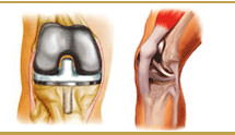 Knee Replacement