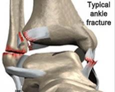 Ankle-Cartilage-Surgery