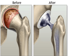 hip replacement surgery in india