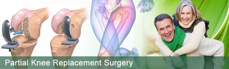 partial knee replacement surgery