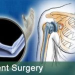 Low Cost Shoulder Replacement Surgery in India