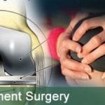 Low Cost Total Knee Replacement Surgery in India