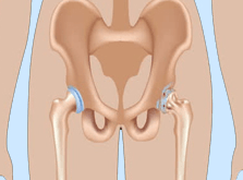 hip replacement surgery in india