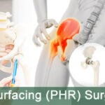 LOW COST Polymotion Hip Resurfacing (PHR) Surgery in India