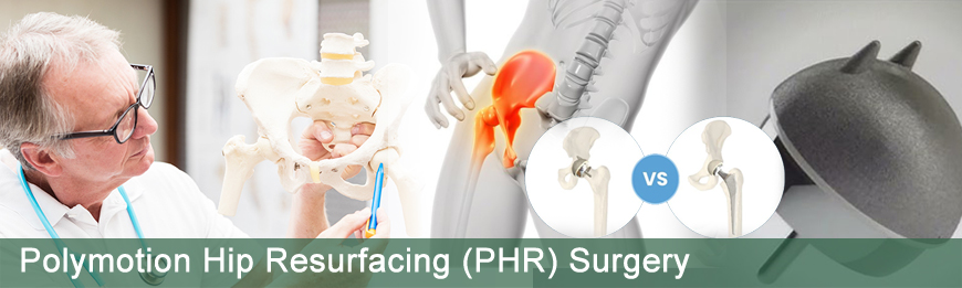 LOW COST Polymotion Hip Resurfacing (PHR) Surgery in India