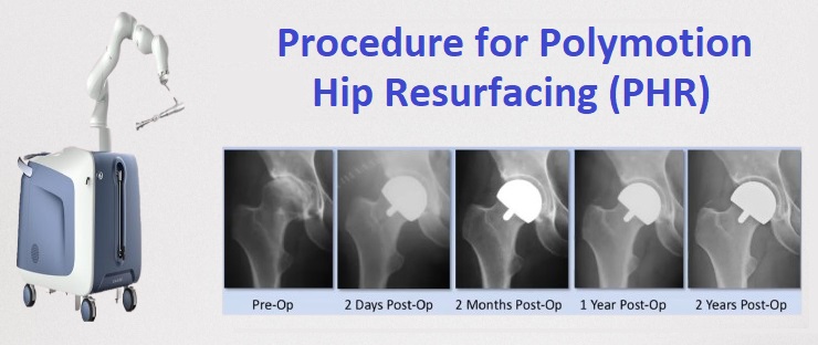Bilateral Knee Replacement Surgery in India